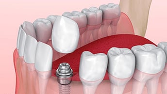 Dentures Cost From $1,000 To $1,500